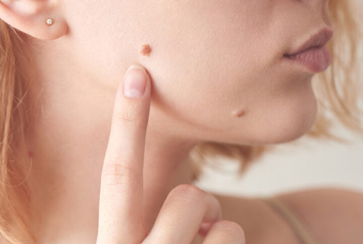 Xóa nốt ruồi, mụn thịt